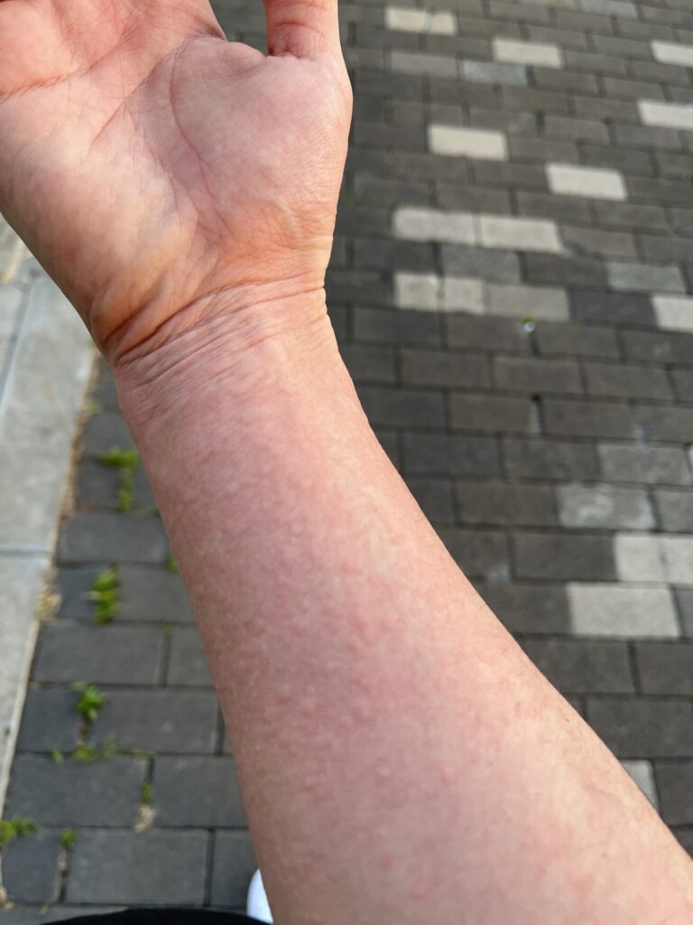 コリン性蕁麻疹実際の画像