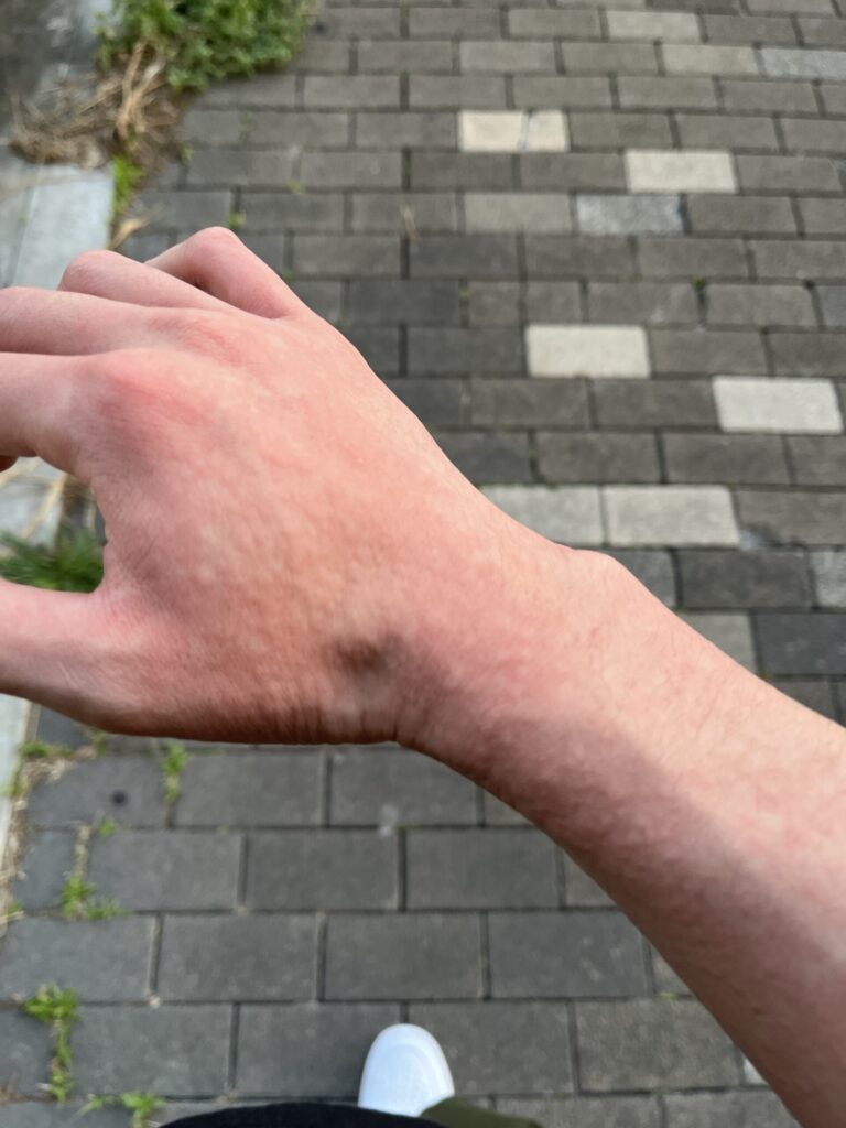 コリン性蕁麻疹実際の画像