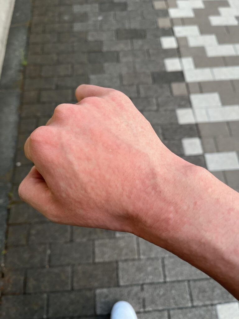 コリン性蕁麻疹実際の画像